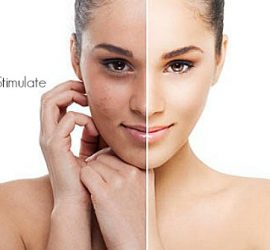 Microdermabrasion Befor and After